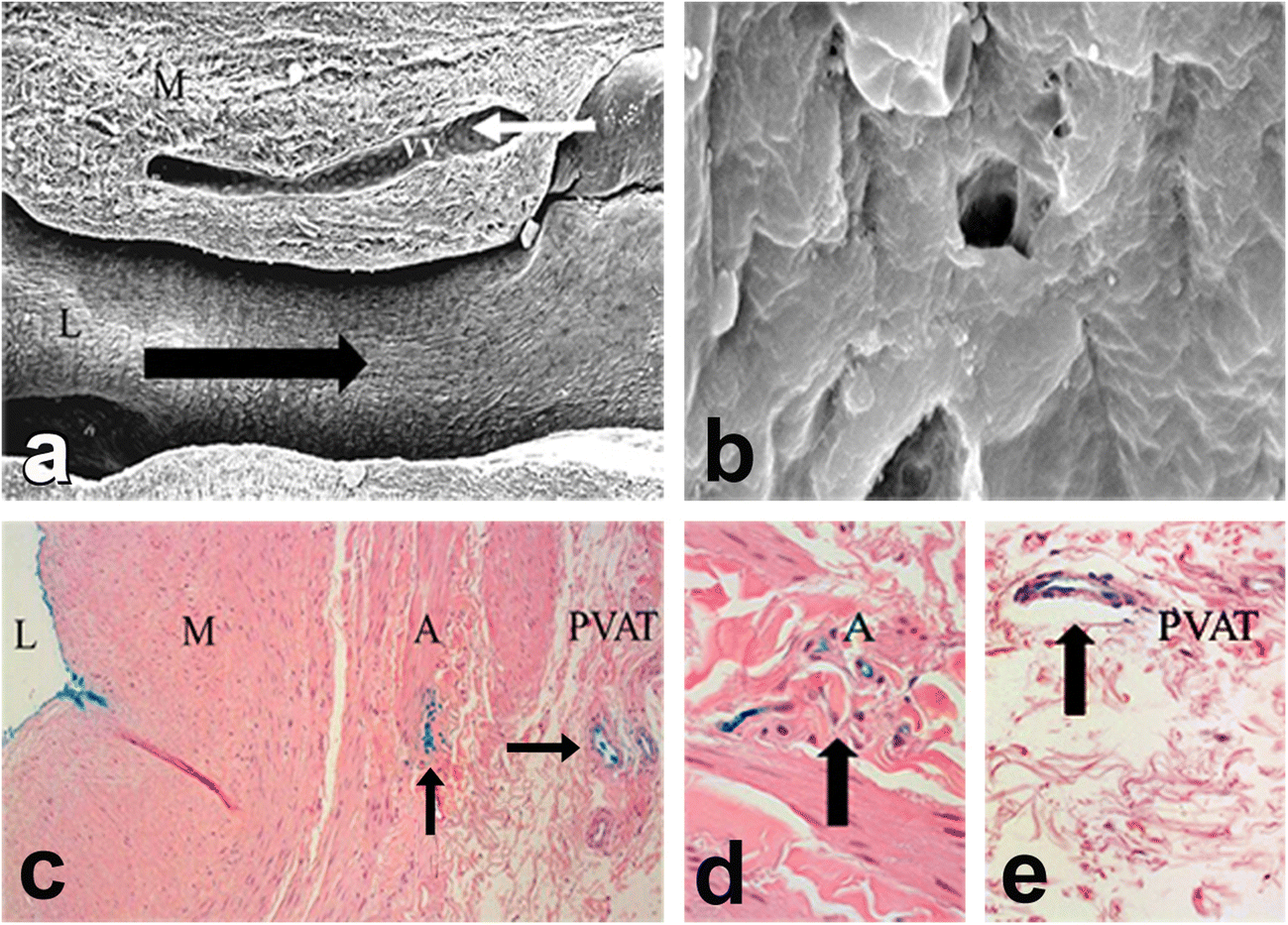 Figure 3 | Vasa vasorum inside out/outside in communication: a potential  role in the patency of saphenous vein coronary artery bypass grafts |  SpringerLink