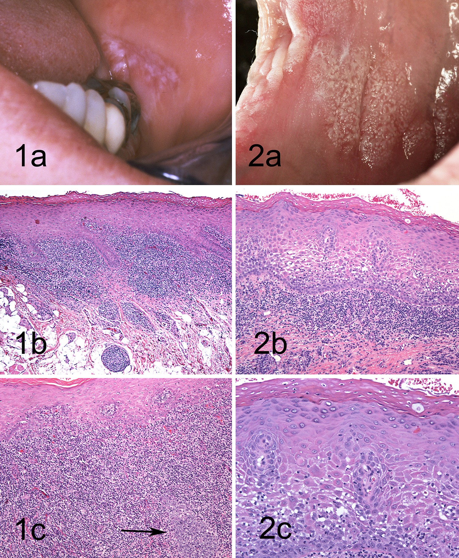 Figure 7 | Frictional Keratosis, Contact Keratosis and Smokeless Tobacco  Keratosis: Features of Reactive White Lesions of the Oral Mucosa |  SpringerLink