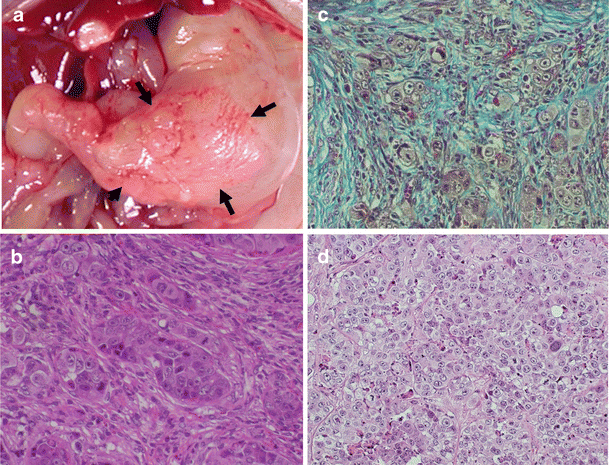 Figure 3 Cancer Stromal Interactions In Scirrhous Gastric Carcinoma Springerlink