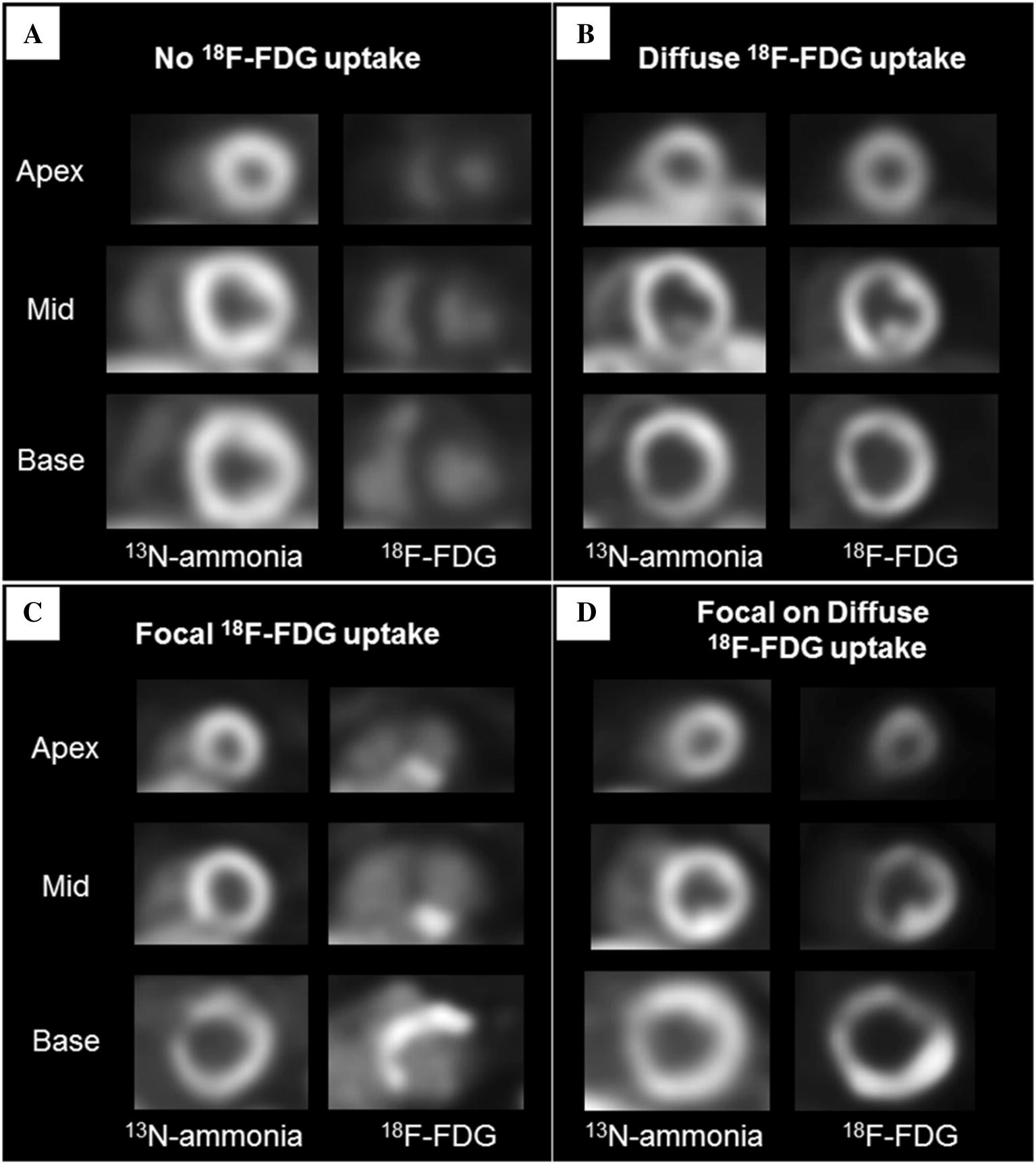 Figure 1 | Suppressing physiologic 18-fluorodeoxyglucose uptake in patients  undergoing positron emission tomography for cardiac sarcoidosis: The effect  of a structured patient preparation protocol | SpringerLink