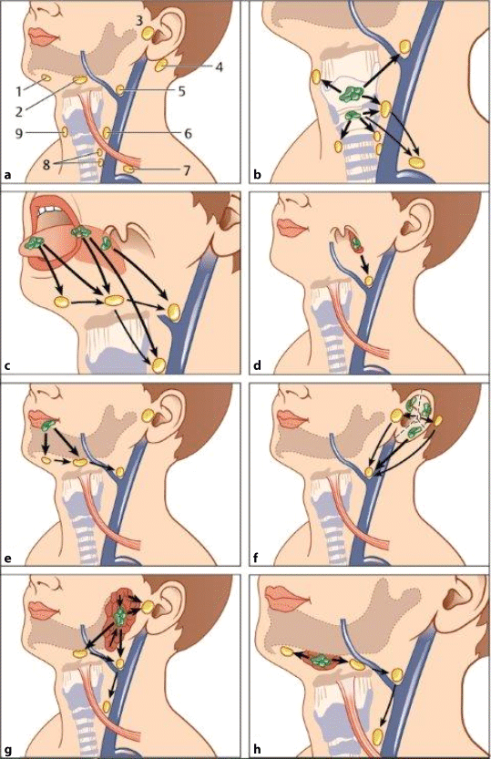 Figure 9 Neck Dissection Springerlink