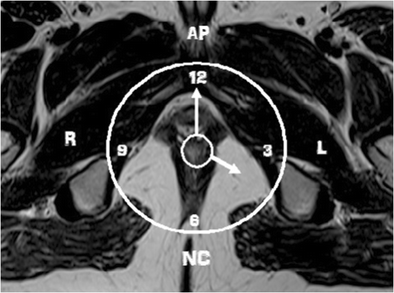 Figure 2 Magnetic Resonance Imaging In Perianal Fistulas A Pictorial Atlas Springerlink Figure 2 Magnetic Resonance Imaging In Perianal Fistulas A Pictorial Atlas Springerlink