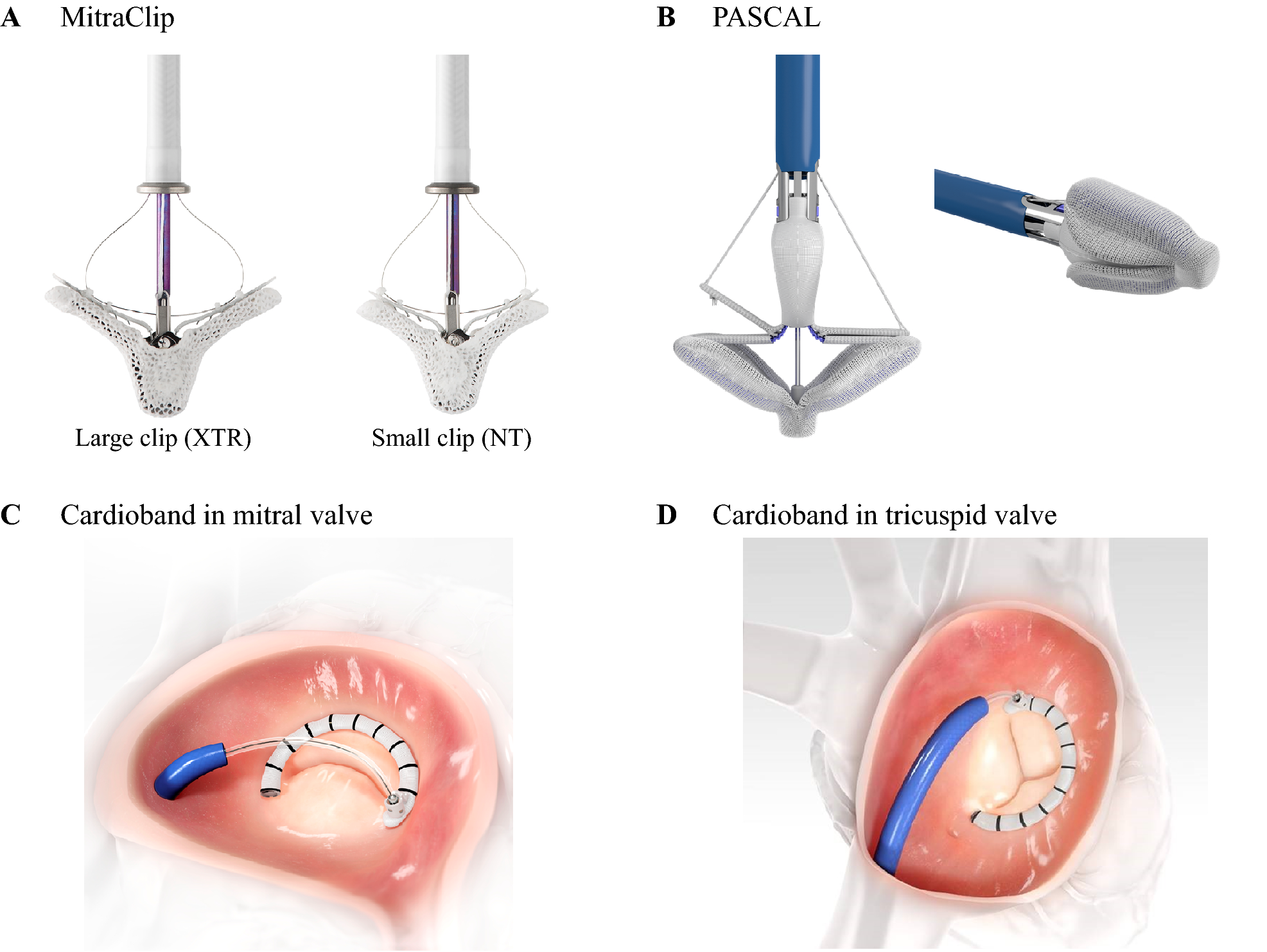Figure 1 | Percutaneous interventions for mitral and tricuspid heart valve  diseases | SpringerLink