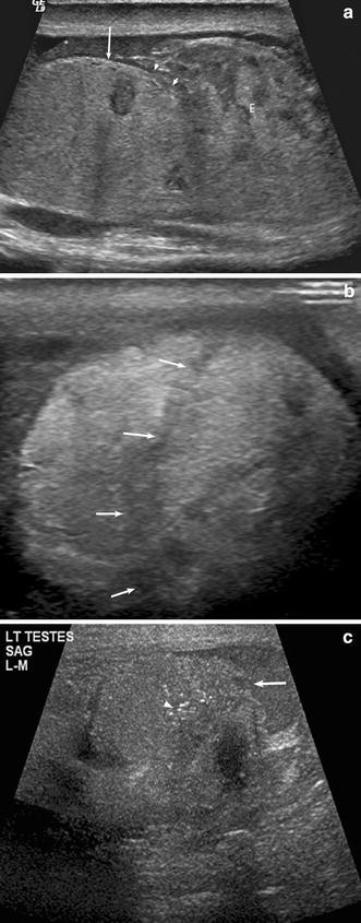 testicular rupture ultrasound