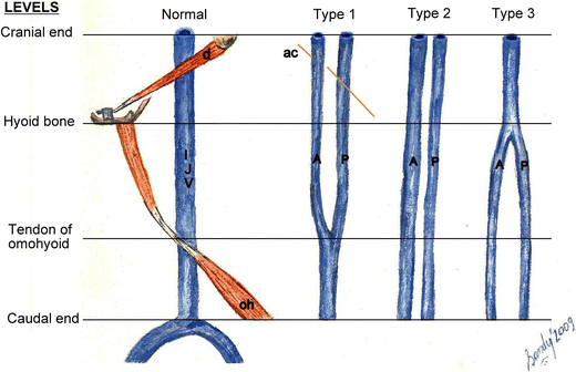 Figure 3 Internal Jugular Vein Duplication Review And Classification Springerlink