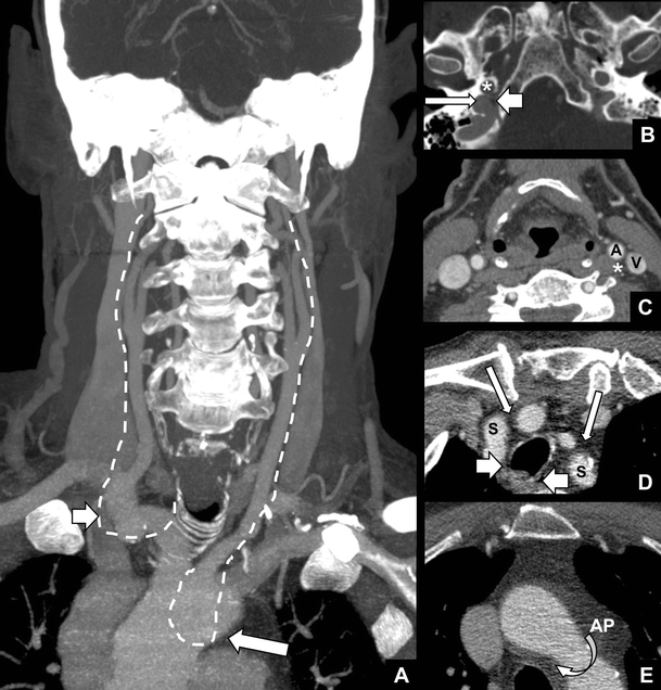 Vocal Cord Paralysis Anatomy Imaging And Pathology Insights Into Imaging Full Text