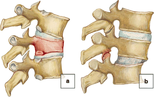abc of degenerative spine