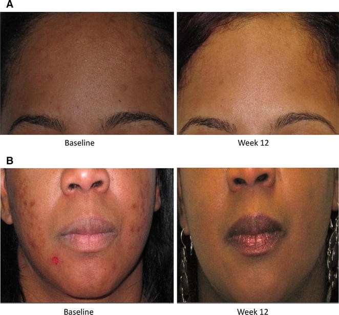 Figure 4 | A Randomized, Double-Blind, Placebo-Controlled Study of a Novel Pantothenic  Acid-Based Dietary Supplement in Subjects with Mild to Moderate Facial Acne  | SpringerLink