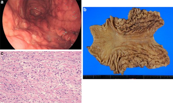 Figure 1 The Significance Of Scirrhous Gastric Cancer Cell Lines The Molecular Characterization Using Cell Lines And Mouse Models Springerlink