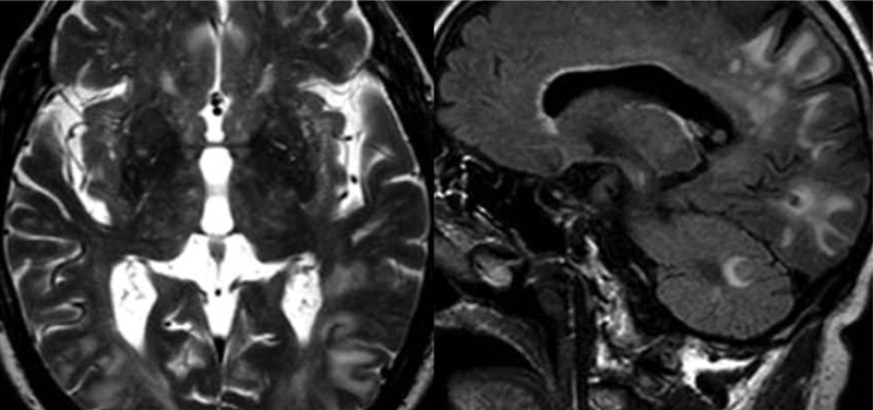 Differenzialdiagnose Und Therapie Akuter Enzephalopathien Springerlink