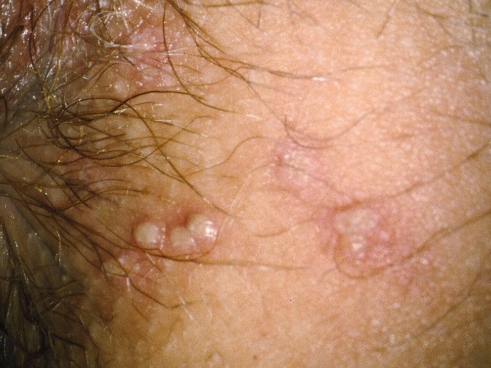 Herpes vaginalis