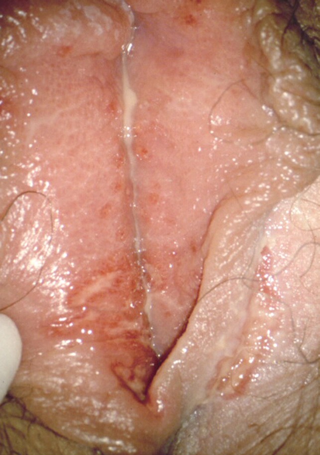 Herpes genitalis symptome Herpes genitalis