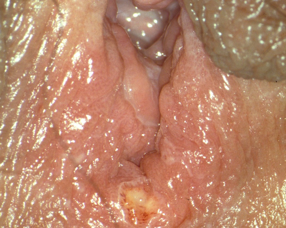Genitalis in der scheide herpes Herpes genitalis: