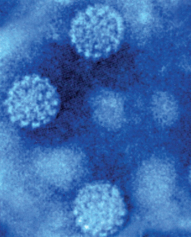 hpv impfung und ms eltávolítva a condyloma szemét