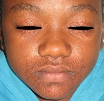 Figure 1 Perioral Dermatitis A Review Of The Condition With Special Attention To Treatment Options Springerlink