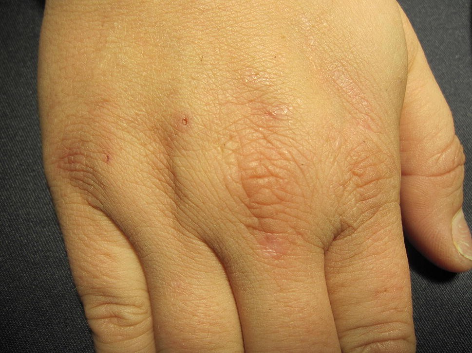 Figure 6 Recent Developments In The Diagnosis And Management Of Photosensitive Disorders Springerlink