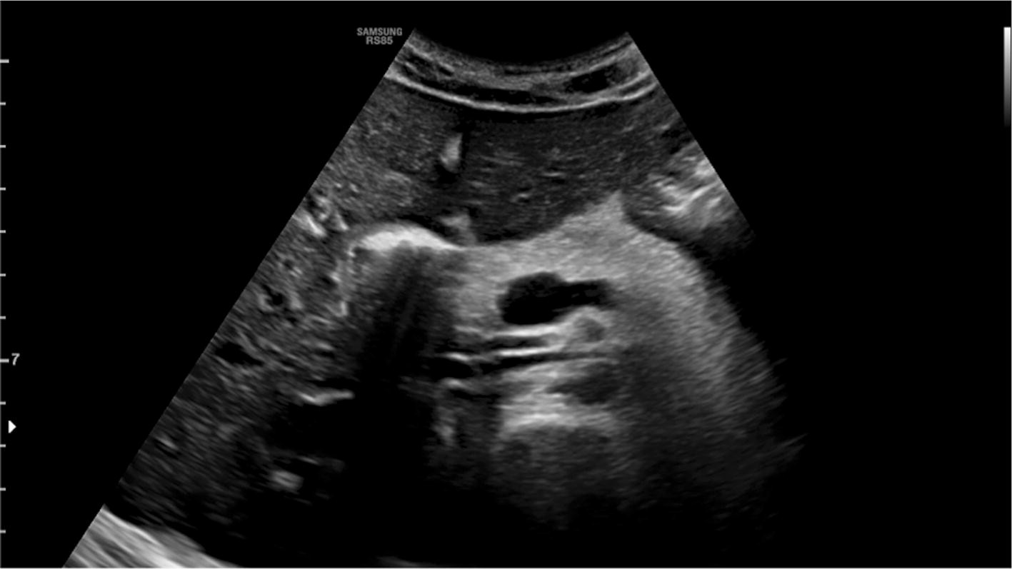 pancreas ultrasound