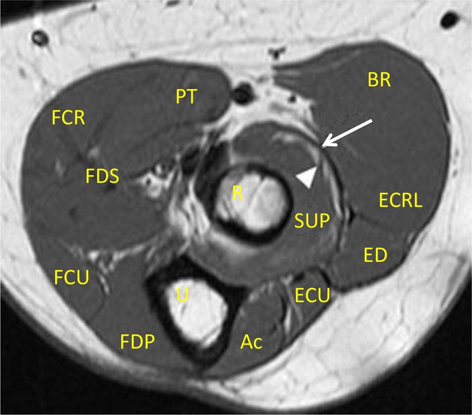 Figure 7 Sonoanatomy Of Anterior Forearm Muscles Springerlink