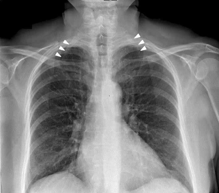 Figure 1 | Thoracic outlet syndrome: a rare case with bilateral cervical  ribs and bilateral anterior scalene hypertrophy | SpringerLink