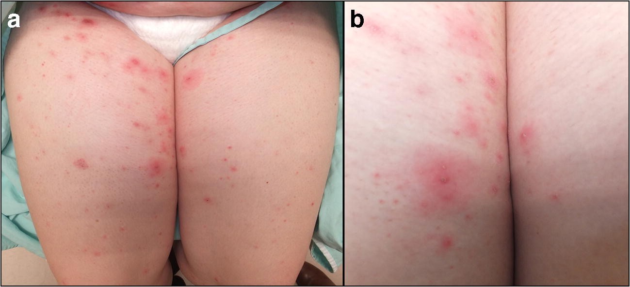 Figure 4 Adverse Cutaneous Reactions Of Common Biologic Medications For Rheumatic Diseases Springerlink