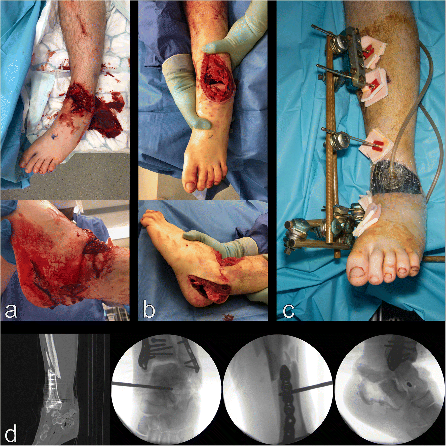 Figure 1 | Amputation in Trauma—How to Achieve a Good Result from Lower  Extremity Amputation Irrespective of the Level | SpringerLink