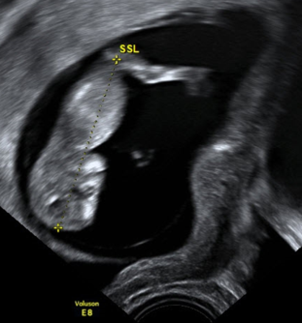 Figure 6 Die Gestationsaltersbestimmung Mit Ultraschall Springerlink