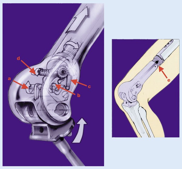 Pediatric Bone Tumors & Expandable Joint Implant