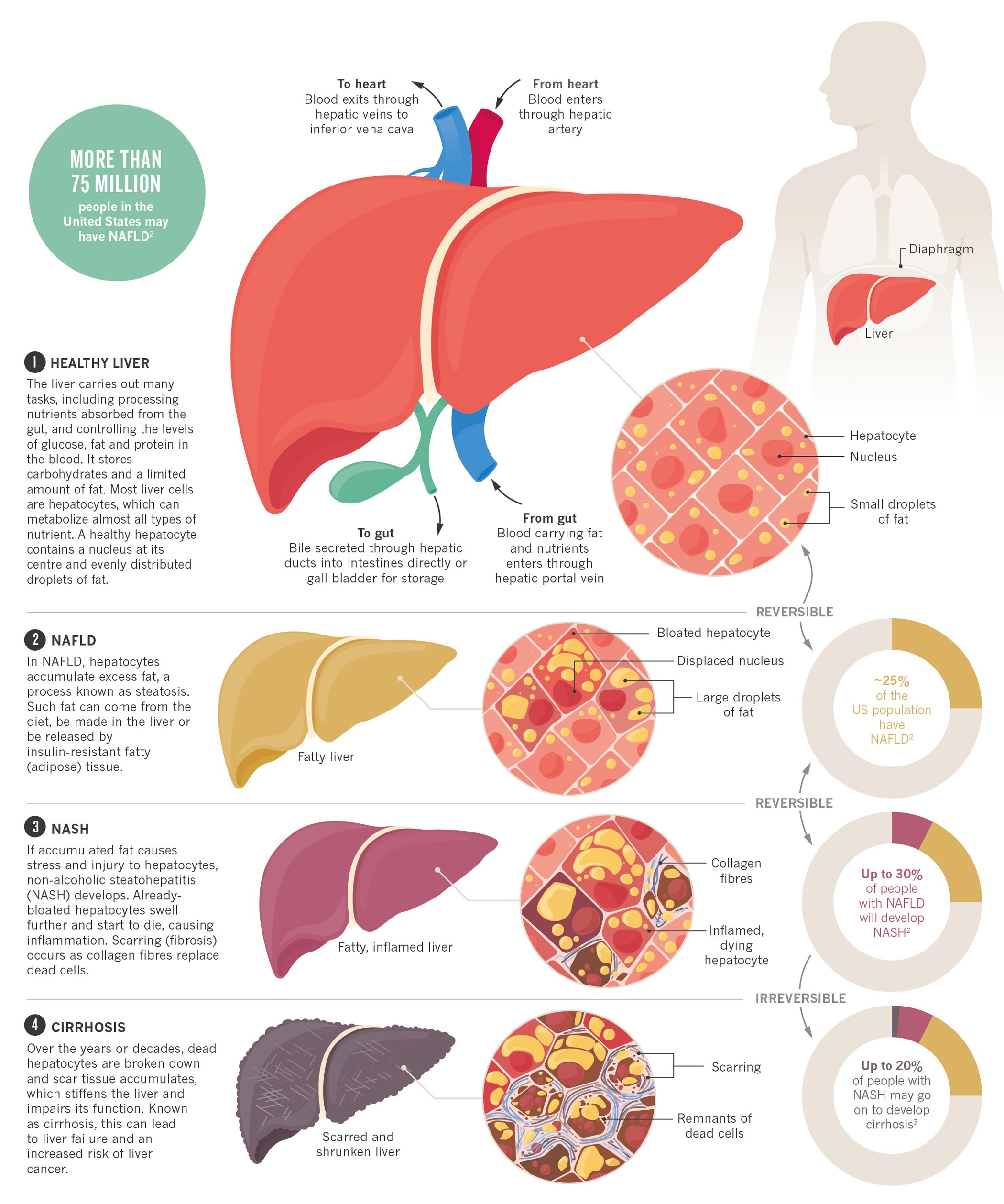 5 natural ways to fight non-alcoholic fatty liver disease – Asian Tribune