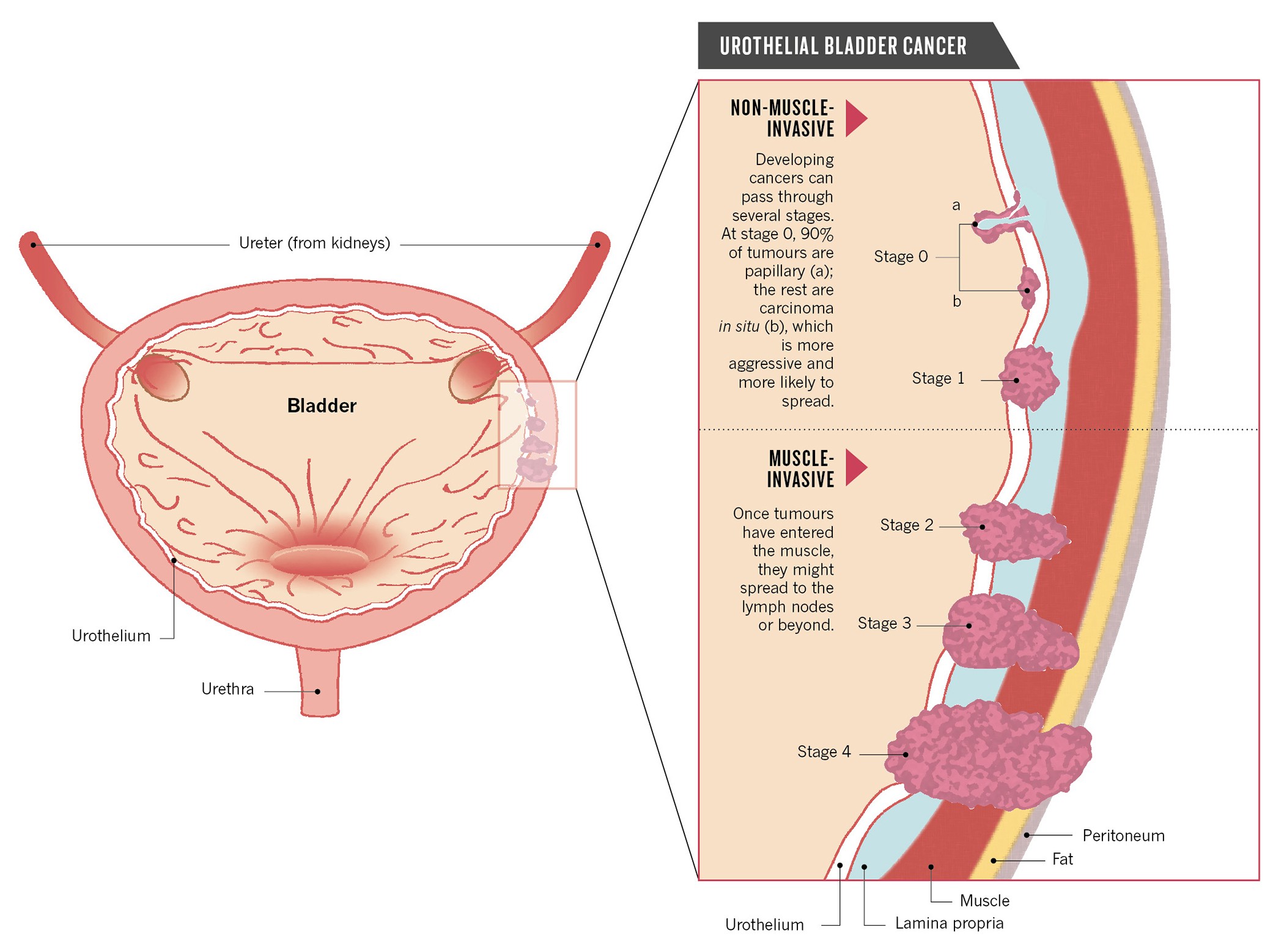 Как выглядит рак мочевого пузыря Unlocking bladder cancer Nature