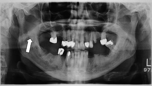 Inferior alveolar nerve, Radiology Reference Article