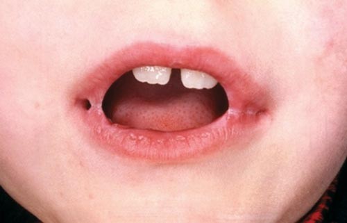 A complication of primary herpetic gingivostomatitis | British Dental  Journal