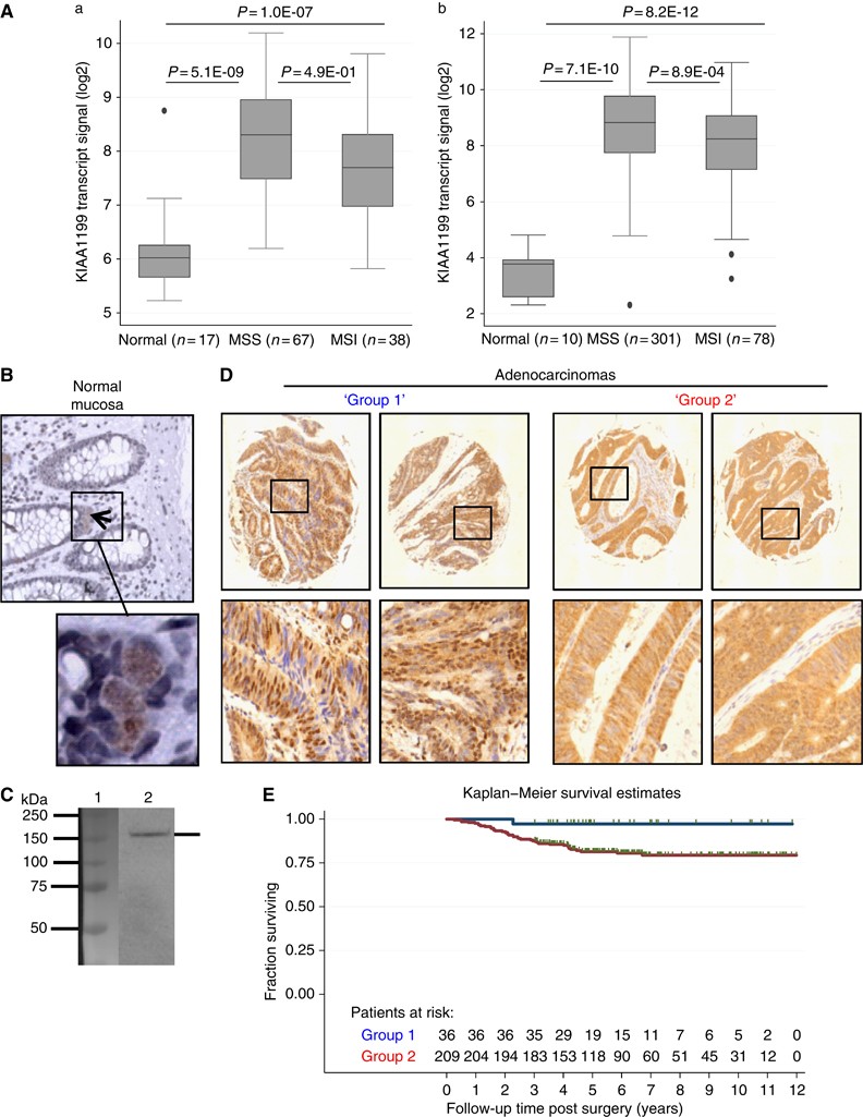 paperback hold rim Repression of KIAA1199 attenuates Wnt-signalling and decreases the  proliferation of colon cancer cells | British Journal of Cancer