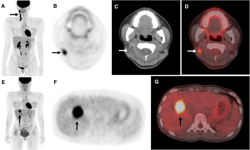 18F-FDG PET/CT surveillance at 3–6 and 12 months for detection of  recurrence and second primary cancer in patients with head and neck  squamous cell carcinoma | British Journal of Cancer