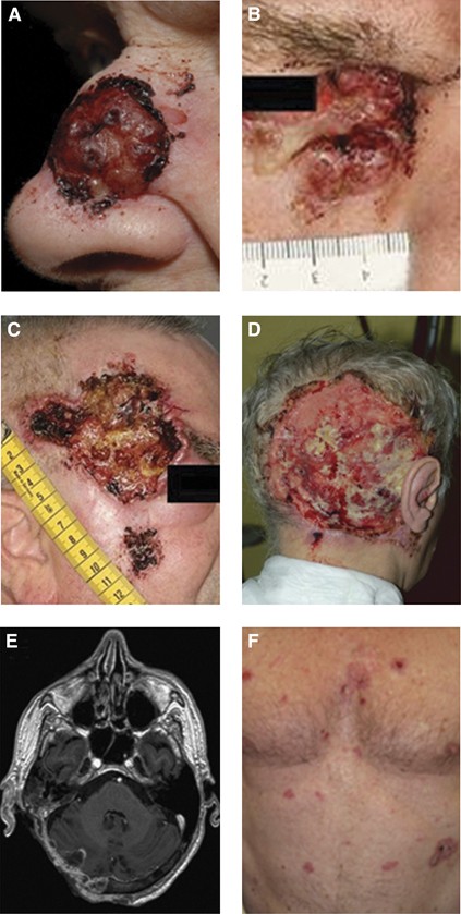 Challenges and new horizons in the management of advanced basal cell  carcinoma: a UK perspective | British Journal of Cancer