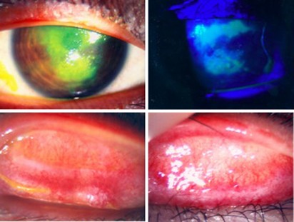 Topical 0.03% tacrolimus ointment in the management of ocular surface  inflammation in chronic GVHD | Bone Marrow Transplantation