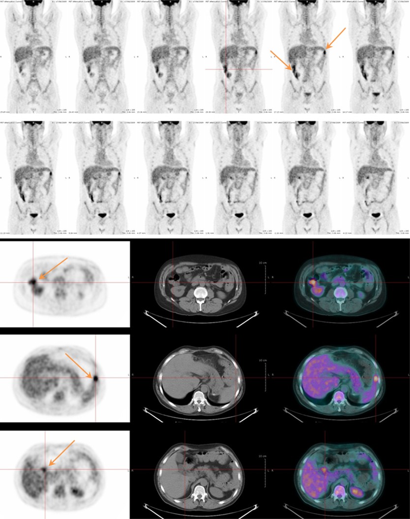 18f Fdg Pet Ct For The Assessment Of Gastrointestinal Gvhd Results Of A Pilot Study Bone Marrow Transplantation 18f Fdg Pet Ct For The Assessment Of Gastrointestinal Gvhd Results Of A Pilot Study Bone Marrow Transplantation