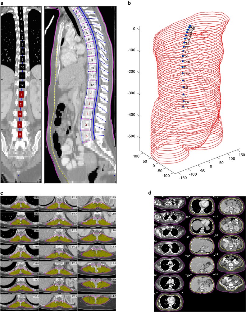 Analytic Morphomics A Novel Ct Imaging Approach To Quantify