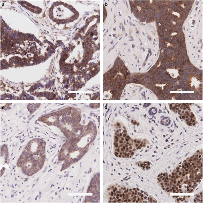 The Malignant Phenotype In Breast Cancer Is Driven By Eif4a1 Mediated Changes In The Translational Landscape Cell Death Disease