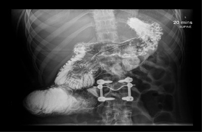 Congenital cataracts following total parenteral nutrition (TPN) use during pregnancy | European Journal of Clinical Nutrition Congenital cataracts following total parenteral nutrition (TPN) use during pregnancy | European Journal of Clinical Nutrition