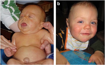 beckwith wiedemann syndrome adult