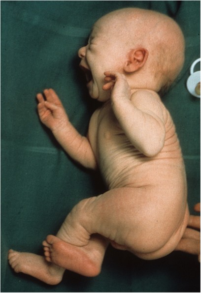 Figure 1 from Role of optic microscopy for early diagnosis of Menkes disease   Semantic Scholar