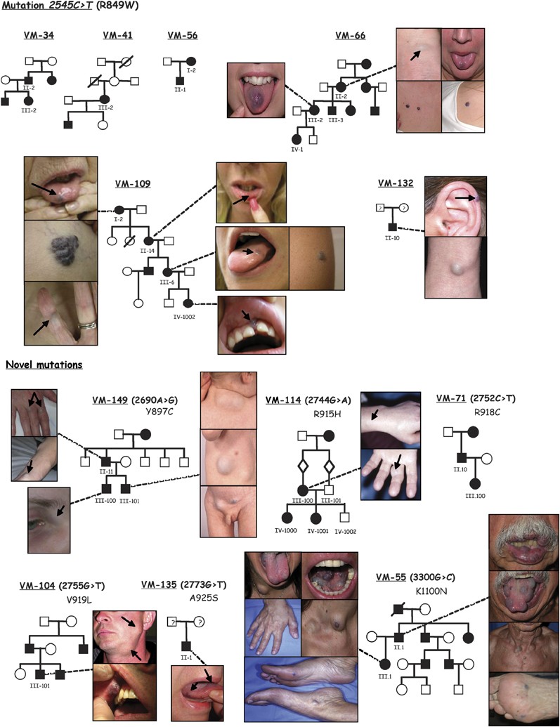 Hereditary cutaneomucosal venous malformations are caused by TIE2 mutations  with widely variable hyper-phosphorylating effects | European Journal of  Human Genetics