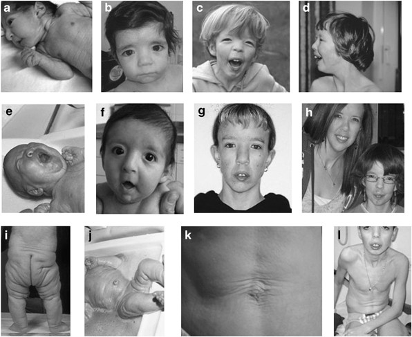 Autosomal recessive cutis laxa syndrome revisited | European Journal of  Human Genetics