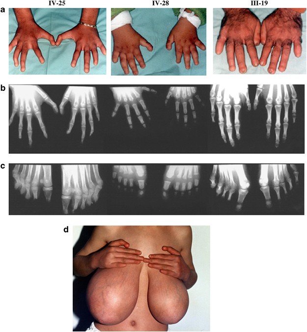 Mammary-digital-nail (MDN) syndrome: a novel phenotype maps to human  chromosome 22q12.3–13.1 | European Journal of Human Genetics