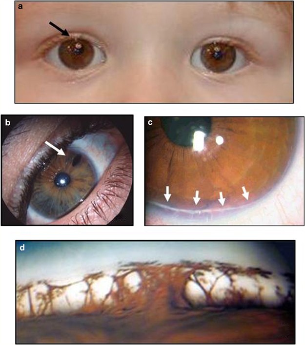 Facial dysmorphism, skeletal anomalies, congenital glucoma