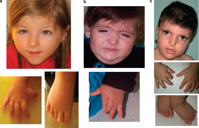 Multiple pilomatricomas in twins with Rubinstein-Taybi syndrome