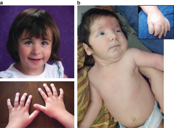 Microdeletions and mutations of CREBBP (CBP) gene can cause