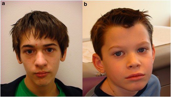 Clinical photos of the patients. (a) Case 1: Dysmorphic facial