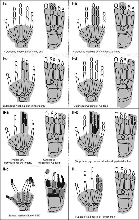 Syndactyly: phenotypes, genetics and current classification | European  Journal of Human Genetics