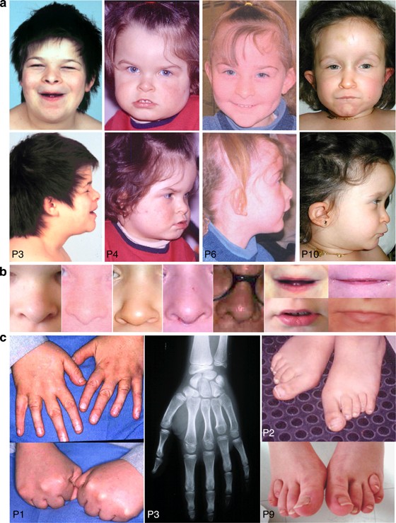 Niet doen oorsprong methodologie The 2q37-deletion syndrome: an update of the clinical spectrum including  overweight, brachydactyly and behavioural features in 14 new patients |  European Journal of Human Genetics